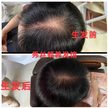 秀丝顿植物养发能够滋养头皮，刺激毛囊，增加发丝的养分供应，从而达到改善白发