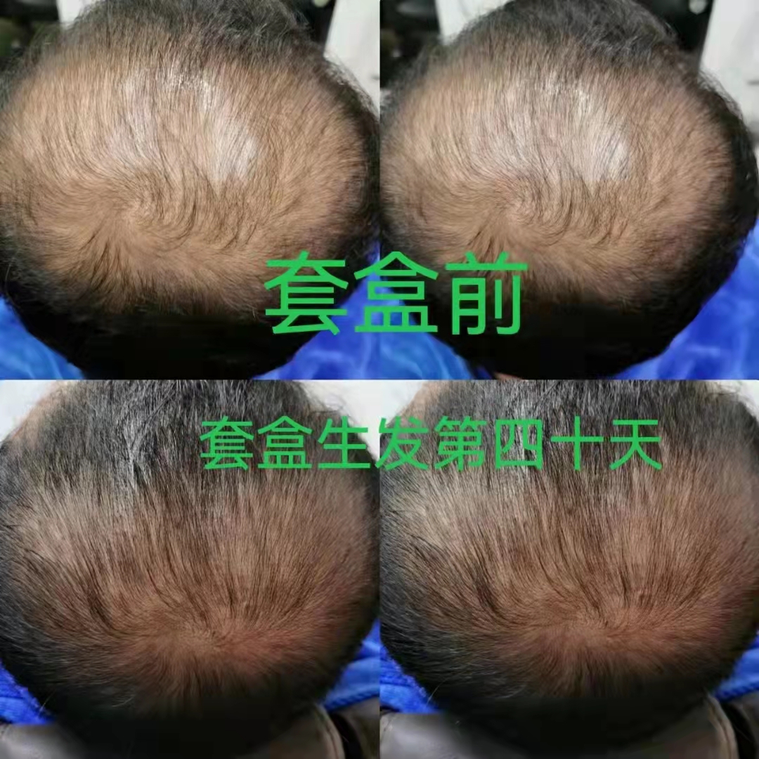 秀丝顿植物养发防脱育发，采用天然植物成分，针对头发问题进行根源性解决