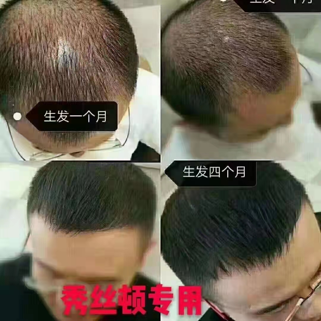 秀丝顿白发养黑”是一种安全、有效的改善白发的办法
