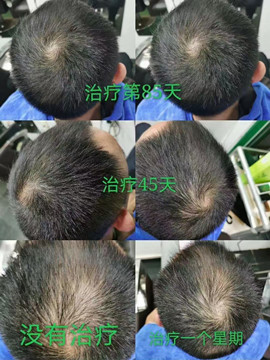 秀丝顿中药头疗改善头油大，头痒，脱发，乌发等功效。