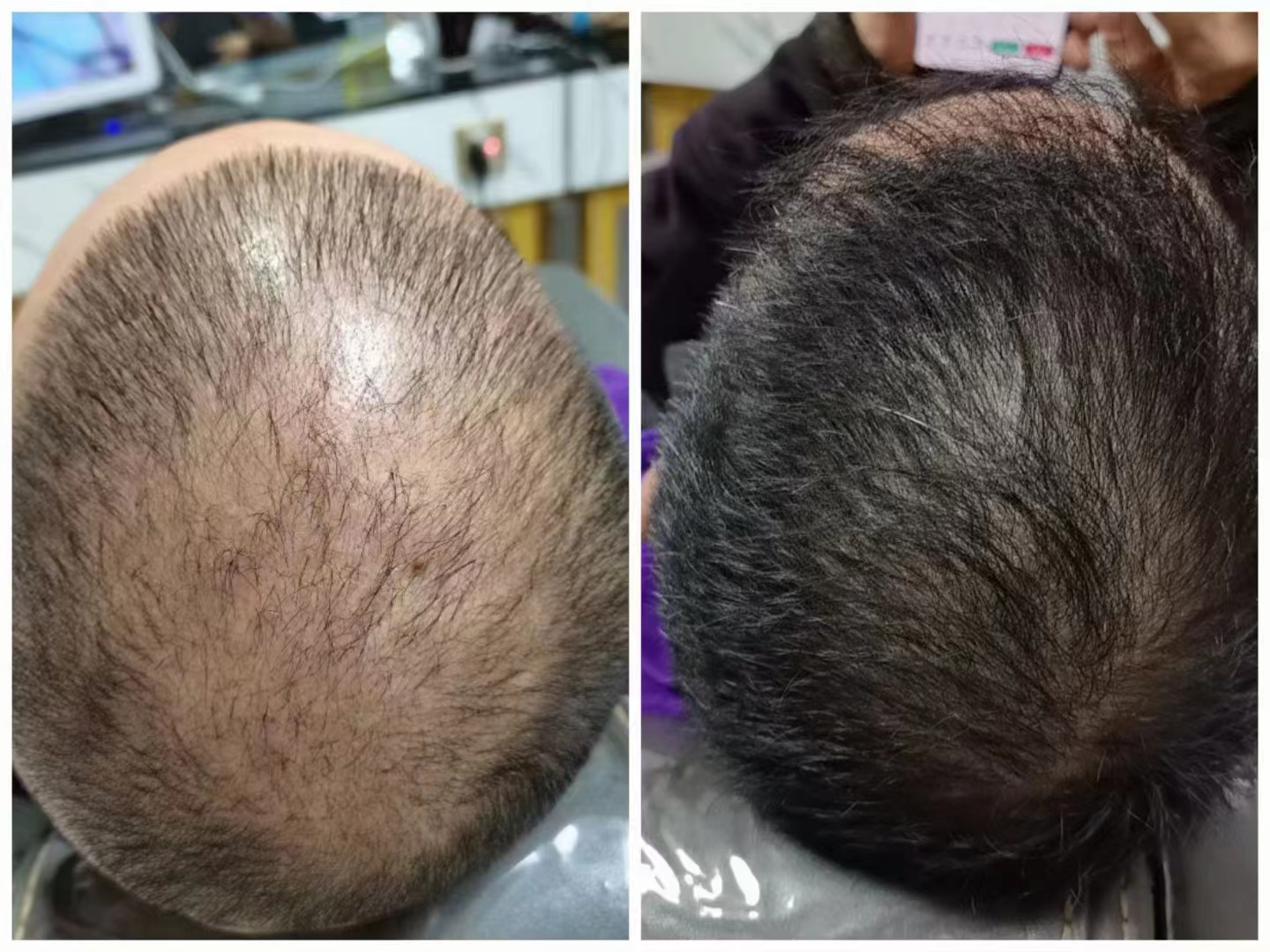秀丝顿植物养发，不仅能够滋养头皮，促进头发生长，还能够有效地将白发养黑