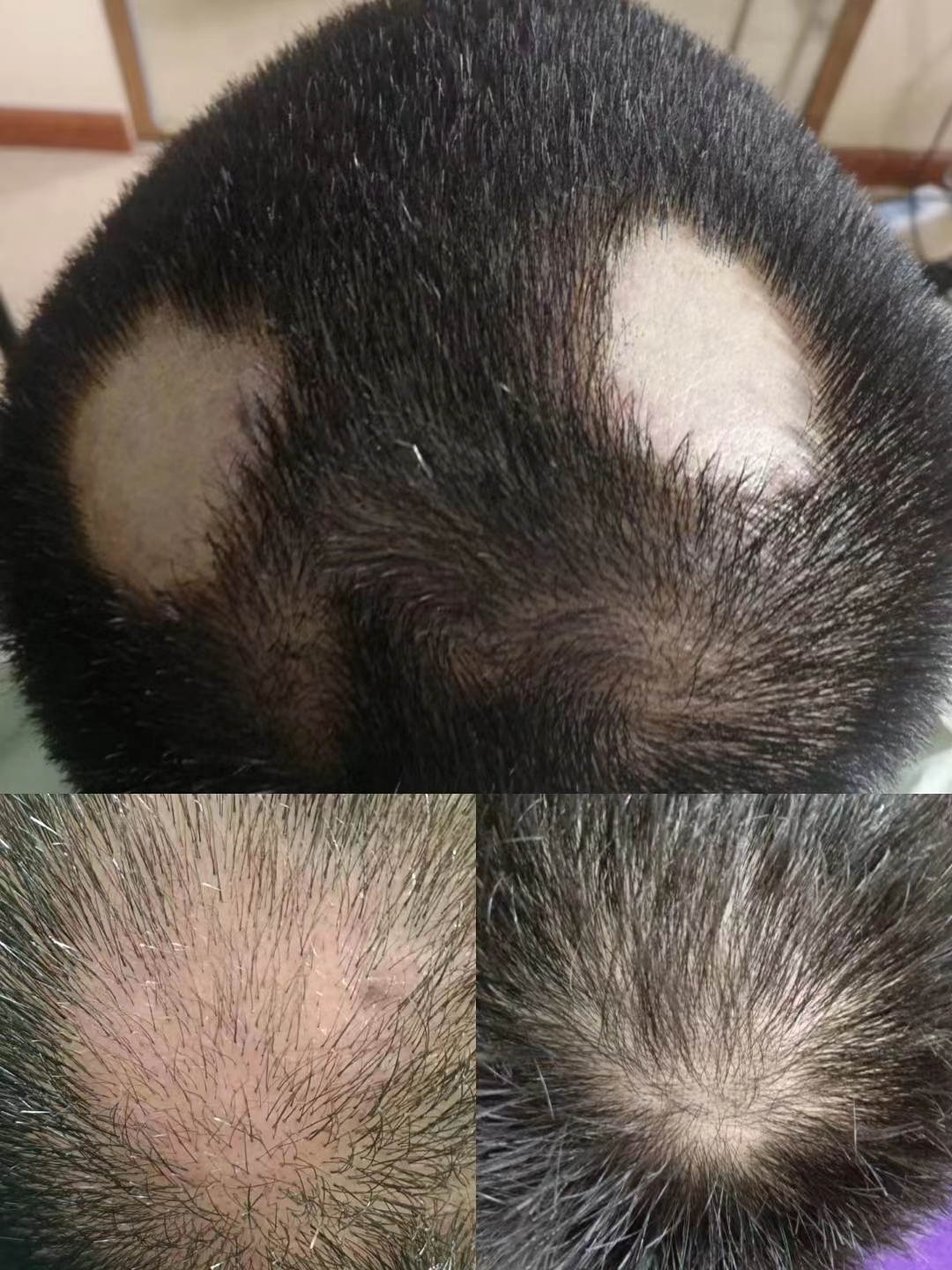 秀丝顿植物养发头部理疗首先用中草药清洗头皮，疏通毛囊，去除皮质栓塞，去除化学残留
