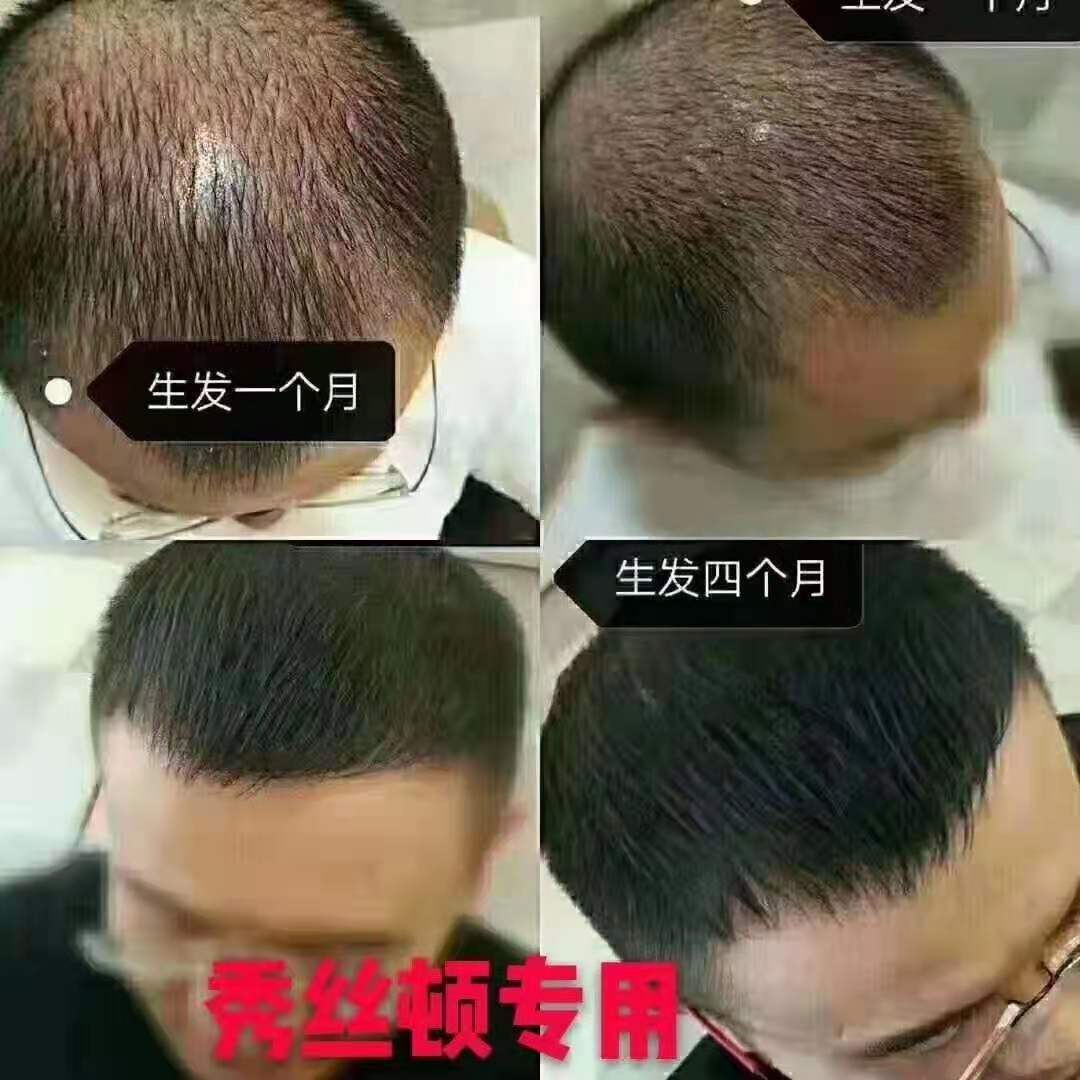 秀丝顿植物养发纯中药提取技术保养毛囊，头皮从而达到防脱，乌发，去油，去屑，止痒，生发的效果。